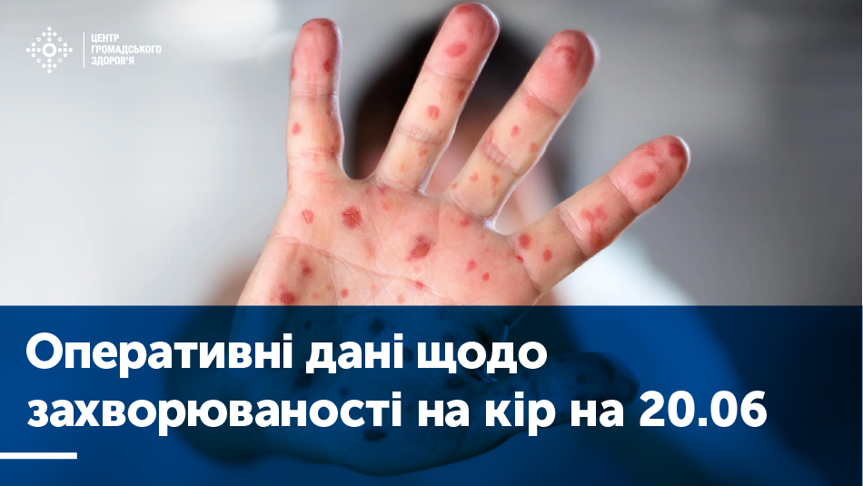 З початку року на кір захворіли близько 55 000 українців. ЦГЗ України закликає регіони проводити «спецоперації» для подолання спалаху