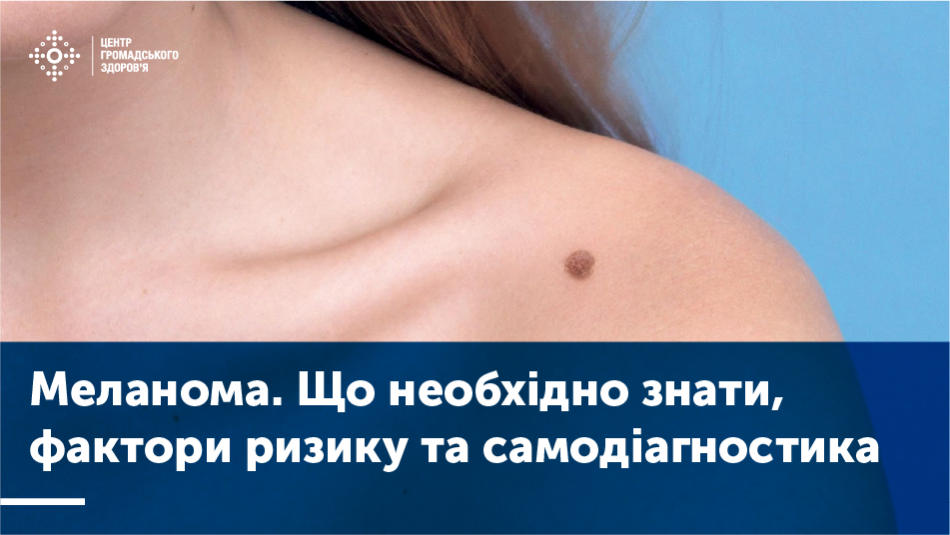 Меланома кожи классификация по тнм и стадиям картинки