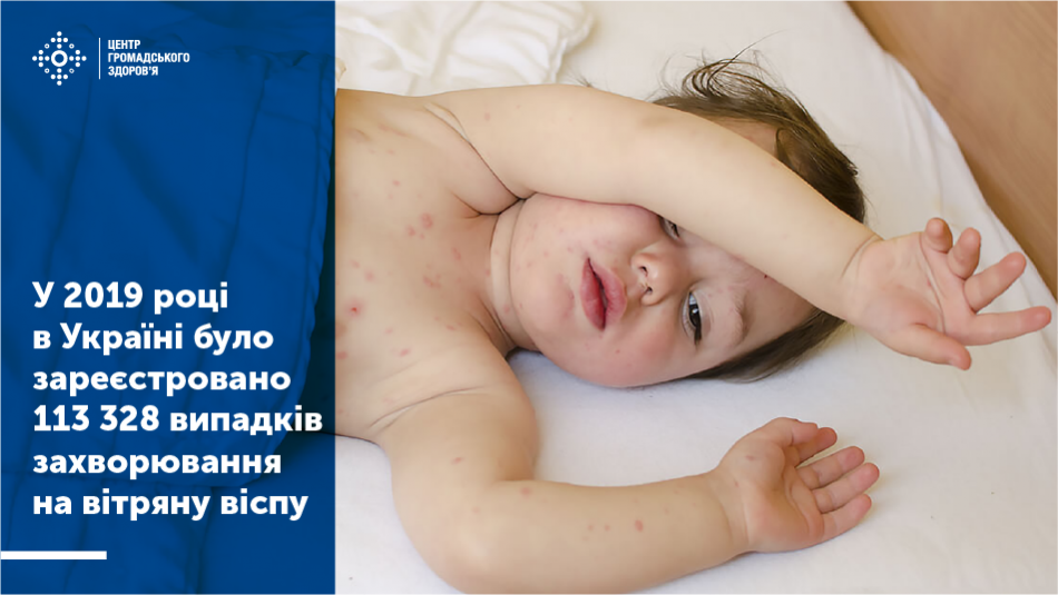 Інкубаційний період під час вітряної віспи триває від 11 до 21 дня, найчастіше близько 14 днів.