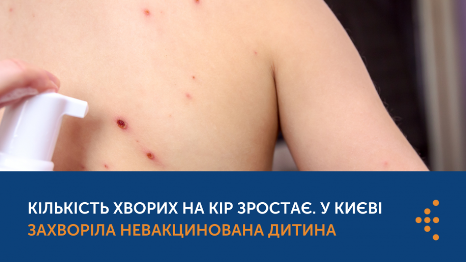 У Києві виявлено новий випадок кору