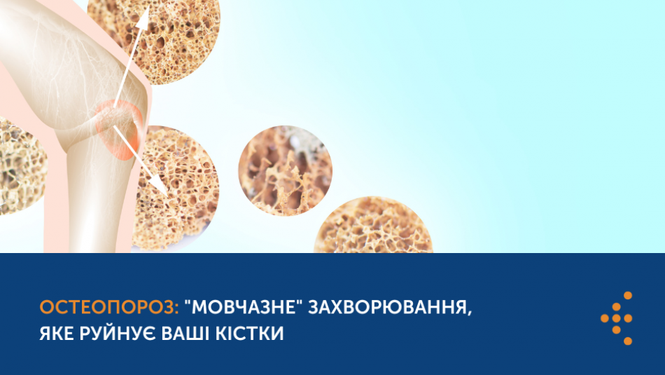 Остеопороз: "мовчазне" захворювання, яке руйнує ваші кістки