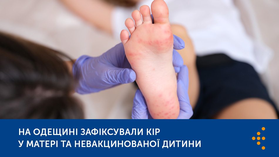 На Одещині зафіксували кір у матері та дитини. Хвора дитина — невакцинована